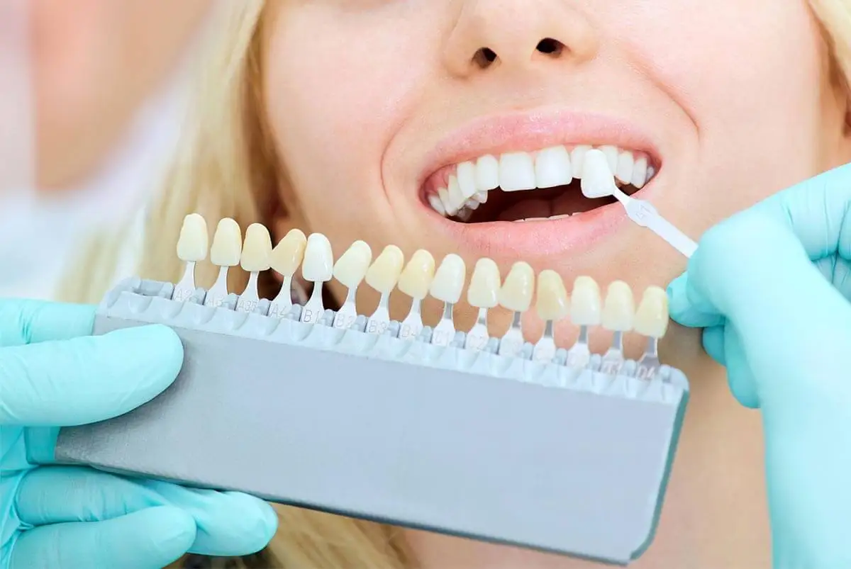 Blanqueamiento dental para quitar manchas.
