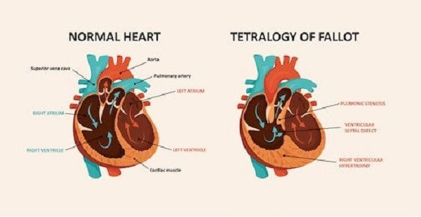 Cardiopatía congénita