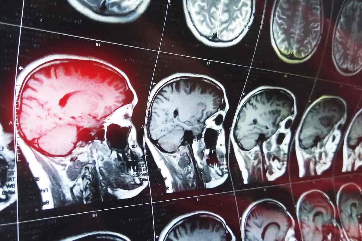 La enfermedad de Alzheimer causa un deterioro progresivo de la memoria y las capacidades cognitivas. Se origina a raíz de la muerte de las células cerebrales.
