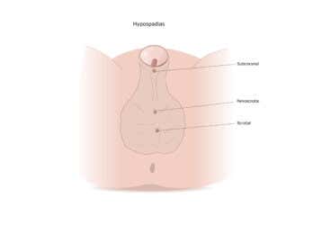 Síntomas y tratamiento del hipospadias