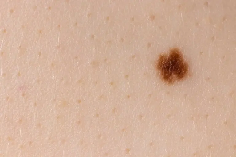 Síndrome del nevus melanocítico congénito