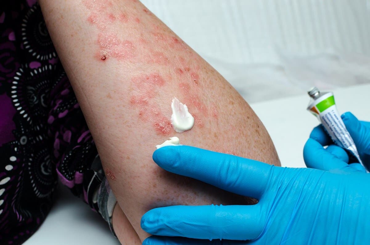 Tratamiento de la psoriasis