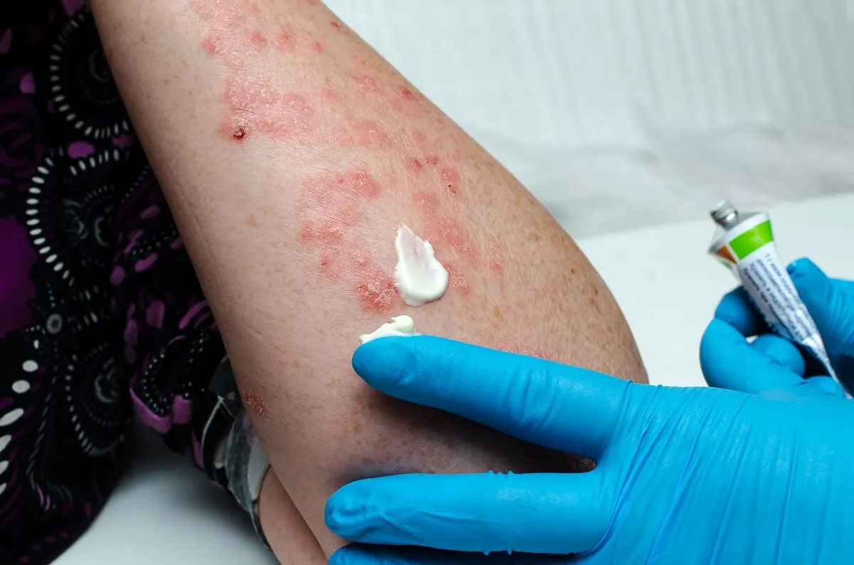 Tratamiento de la psoriasis