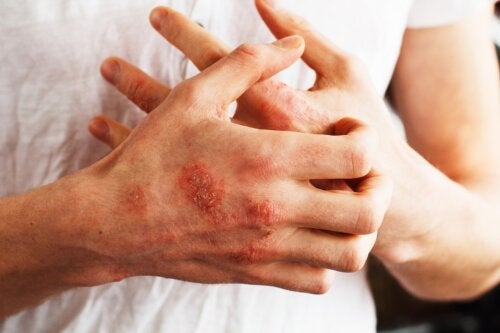 Psoriasis