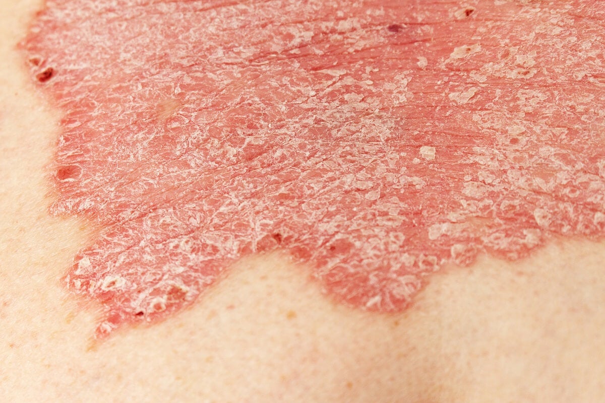 La psoriasis se caracteriza principalmente por una manchas escamosas de aspecto que rojizo, las cuales pueden arder, e incluso, sangrar.