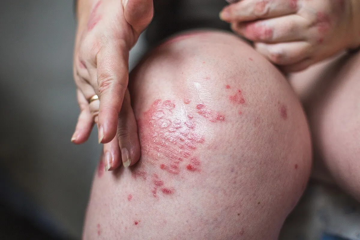 Psoriasis en la psicodermatología.