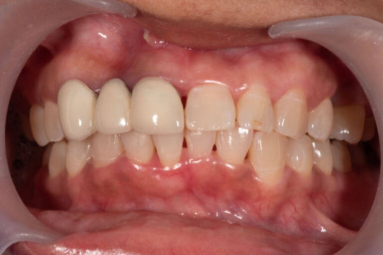 ¿Qué es un absceso dental y cómo debe tratarse?