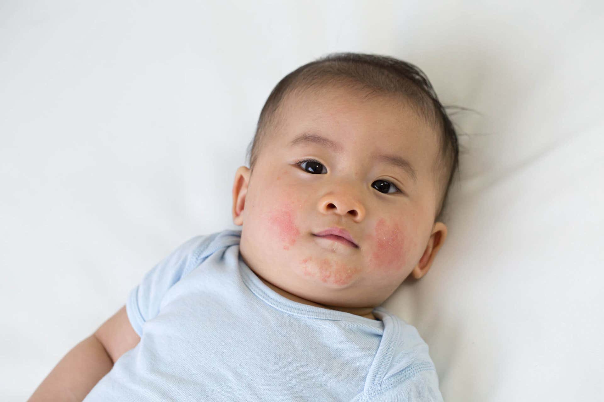 Si el bebé llora después de alimentarse puede deberse a una alergia.