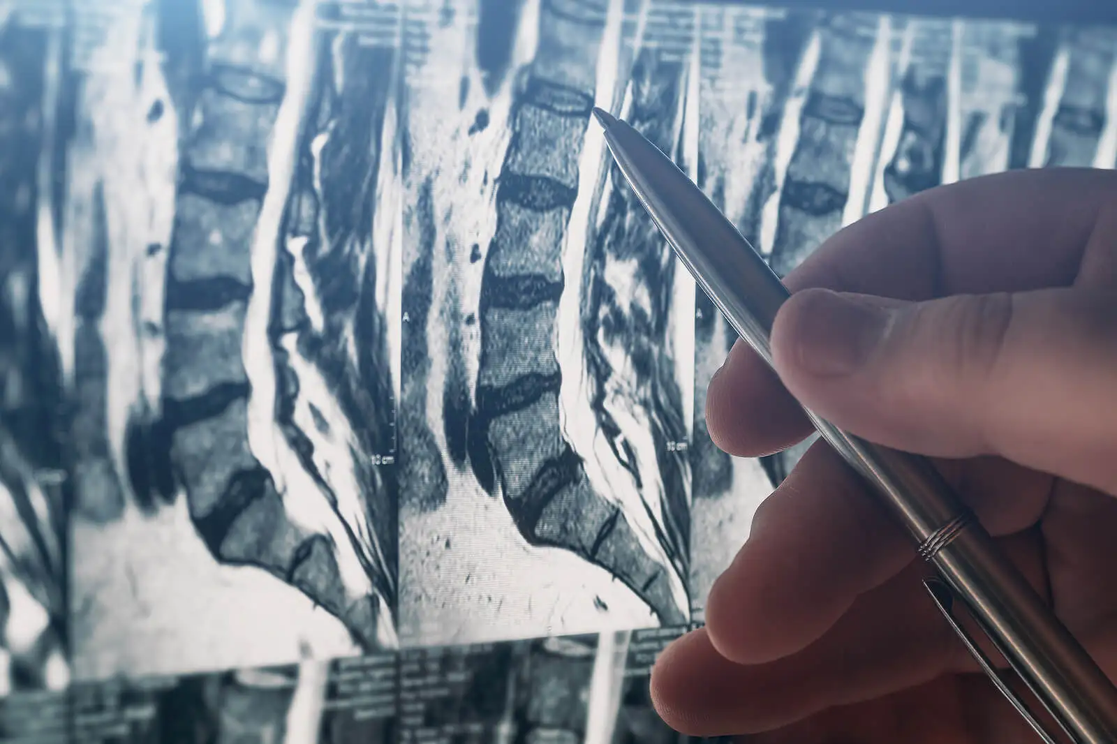 Radiographie de la colonne vertébrale pour la sacro-iliite.