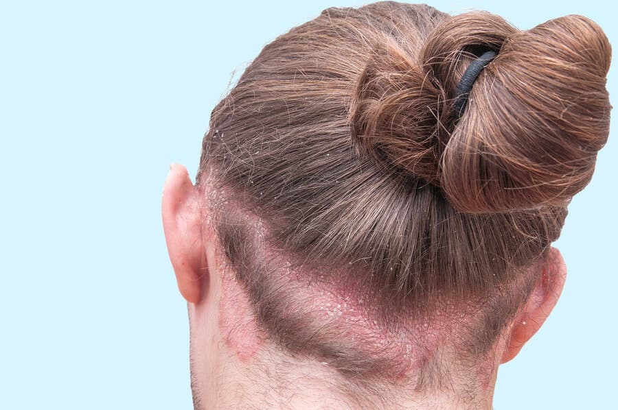 Dermatite séborrhéique traitée avec Multani mutti.