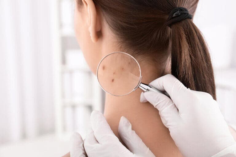 Principales características del pilomatricoma múltiple