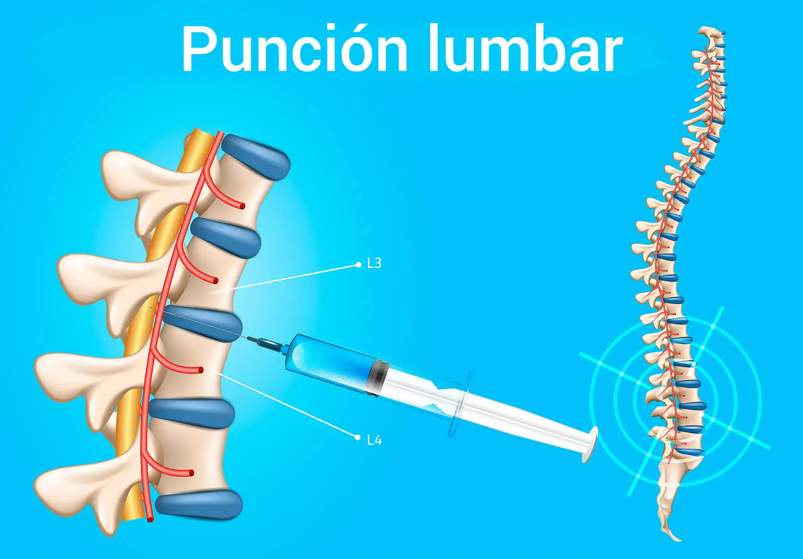 Punción lumbar