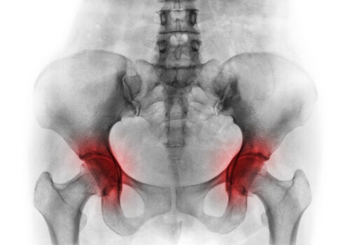 Necrosis avascular de la cabeza femoral