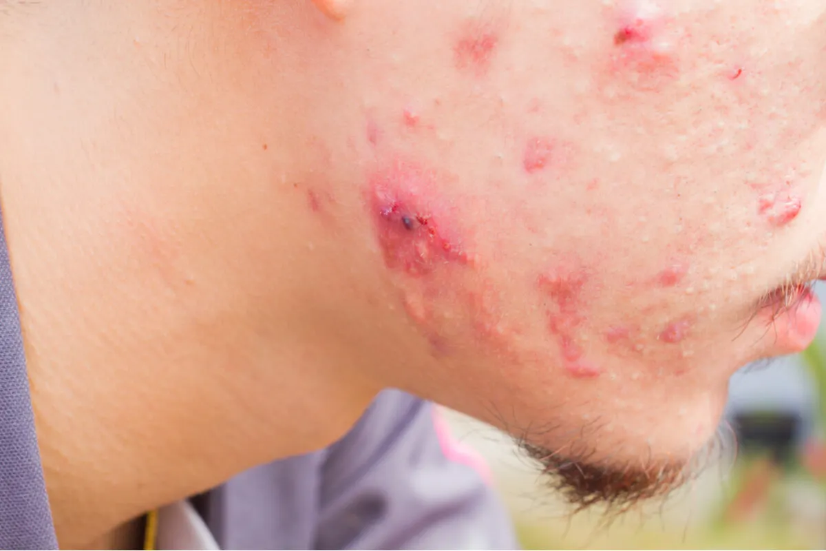 Acné que se trata con microdermoabrasión.