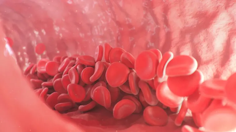 Displasia fibromuscular: diagnóstico y tratamiento