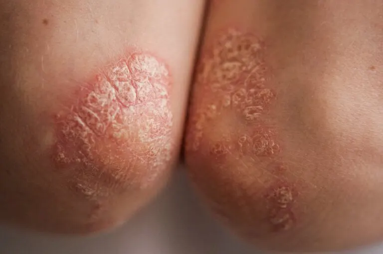 Artritis psoriásica: diagnóstico y tratamiento