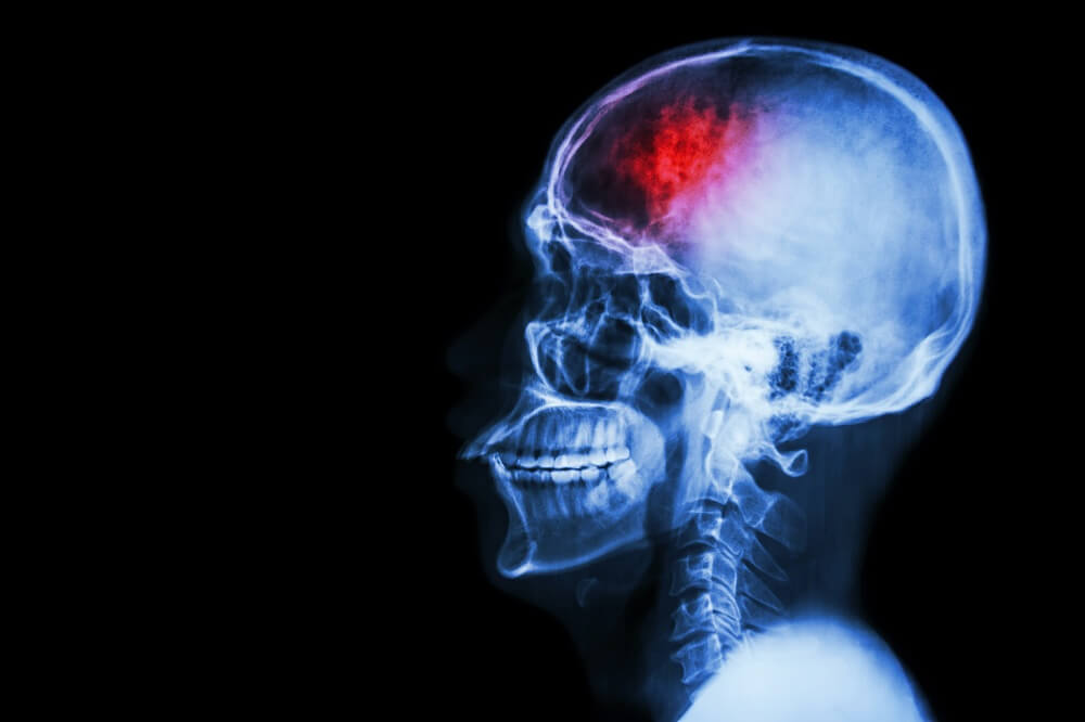 Linksseitige Kopfschmerzen - Röntgenbild