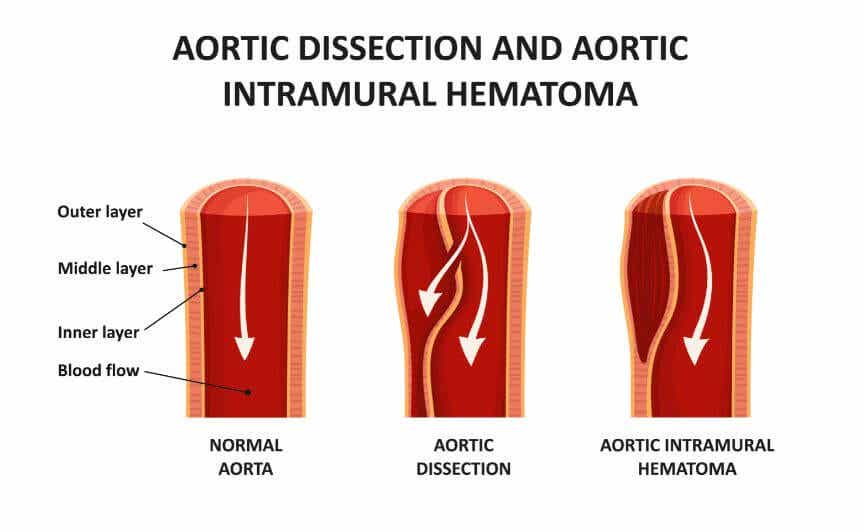 disección aórtica arteria vasos
