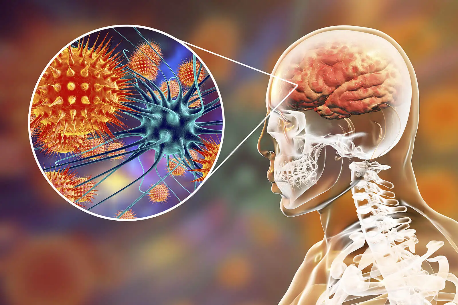 Encefalitis viral.