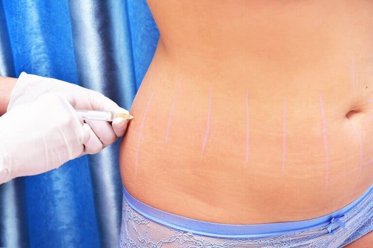 ¿Qué es y para qué se utiliza la lipoterapia?