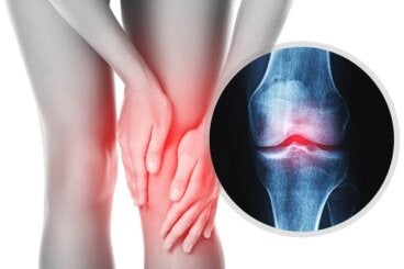 Luxación de rodilla: causas, tratamiento y rehabilitación