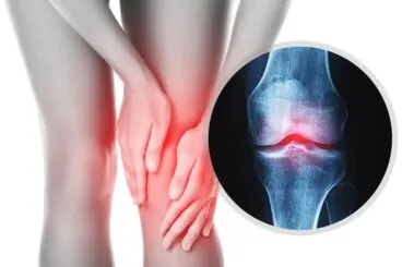 Luxación de rodilla: causas, tratamiento y rehabilitación