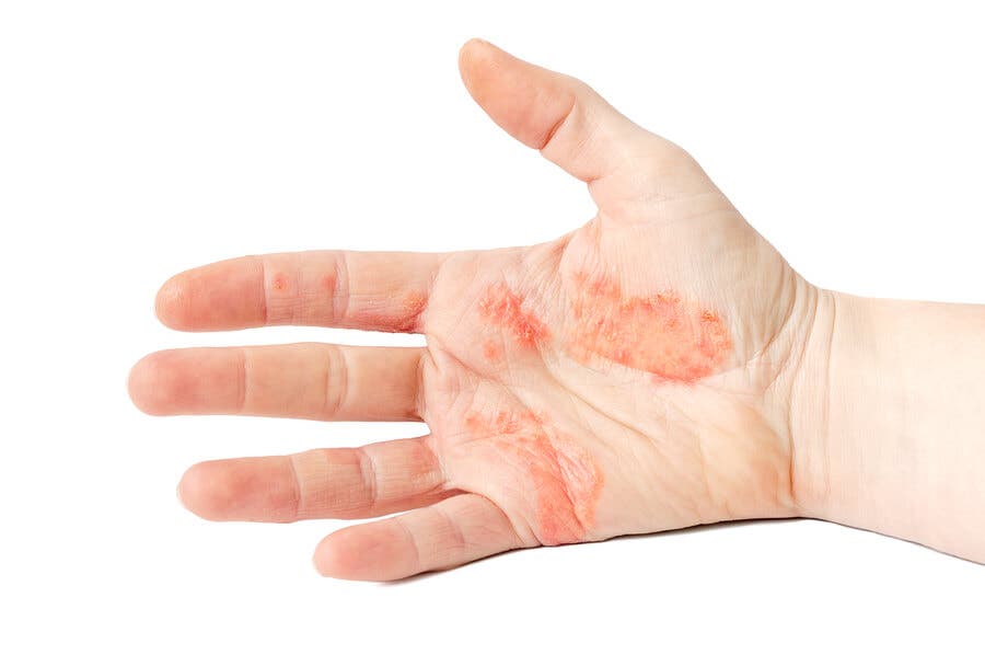 Mano con dishidrosis palmar