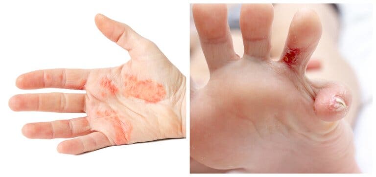 ¿Qué es la dishidrosis palmar y plantar?