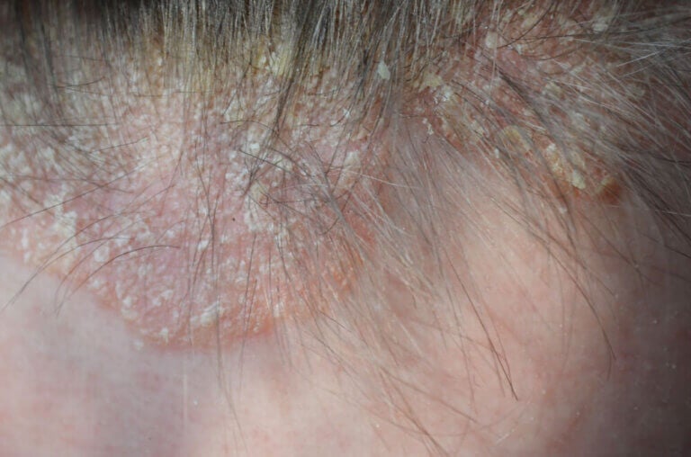 Psoriasis en el cuero cabelludo: síntomas y tratamiento