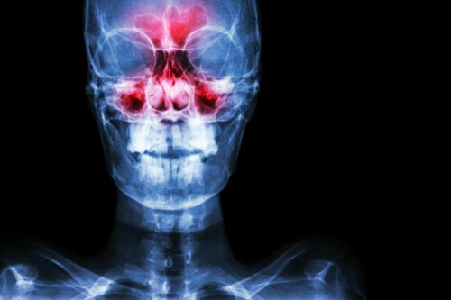 Sinusitis