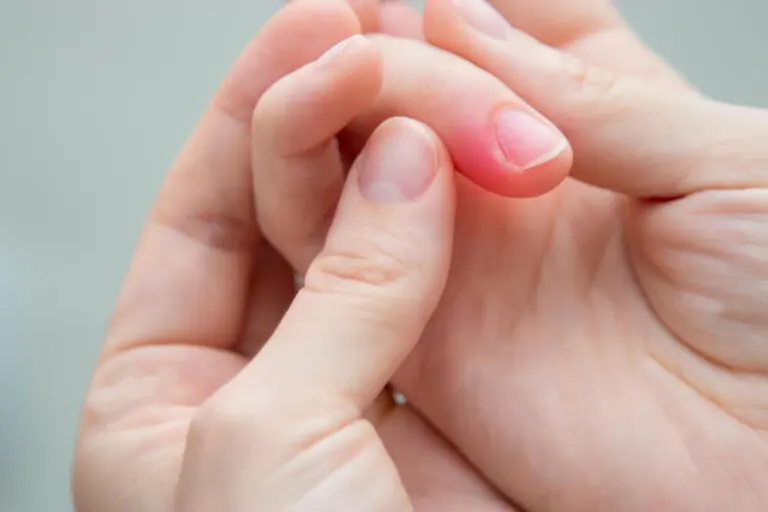 Remedios para los uñeros: 5 opciones naturales