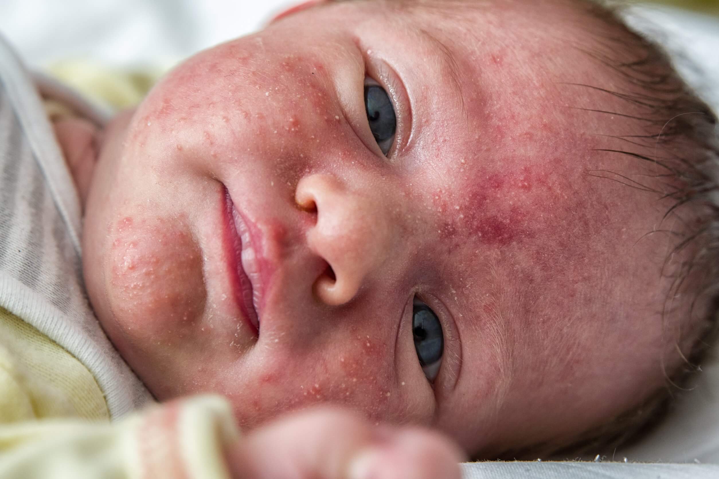 La costra láctea no es lo mismo que el acné neonatal