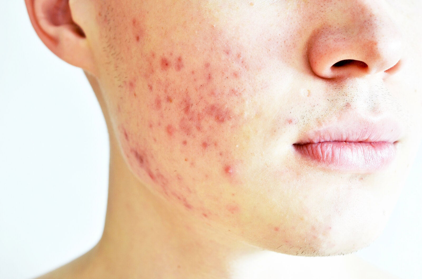 El acné conglobata es una forma severa de acné que debe tratarse precozmente.