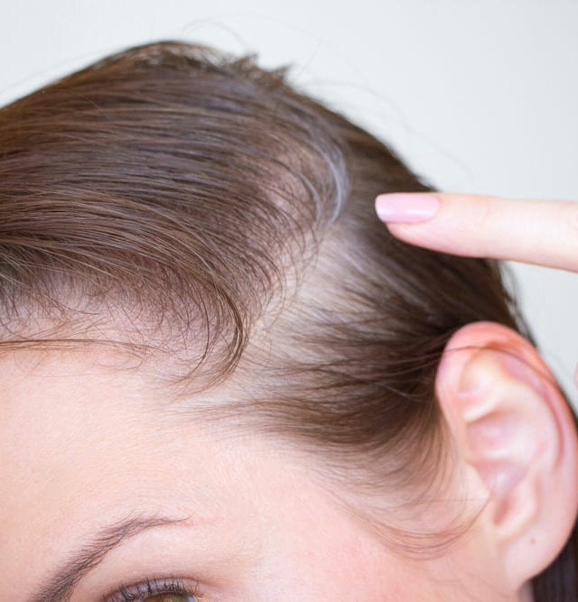 la alopecia postparto? - con Salud