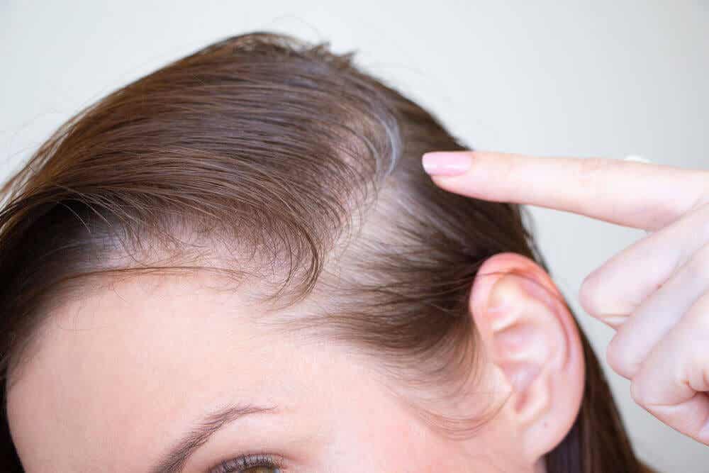 ¿Qué sabes de la alopecia postparto?
