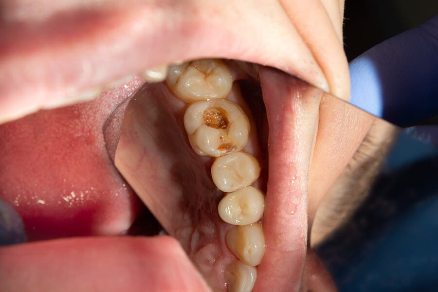 Dientes con caries