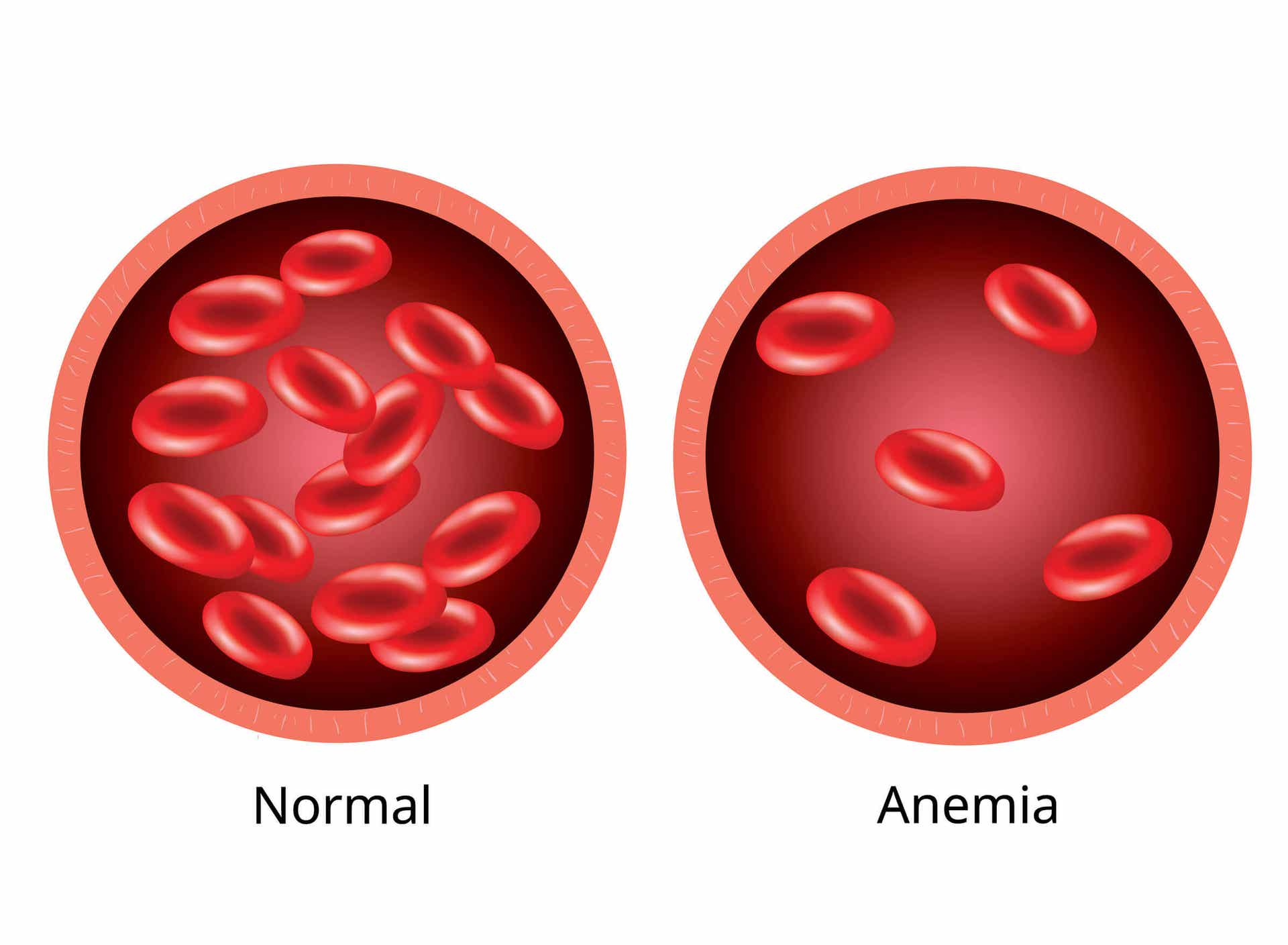 La anemia en niños se debe a problemas con los glóbulos rojos.