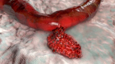 Hemorragia subdural o subaracnoidea