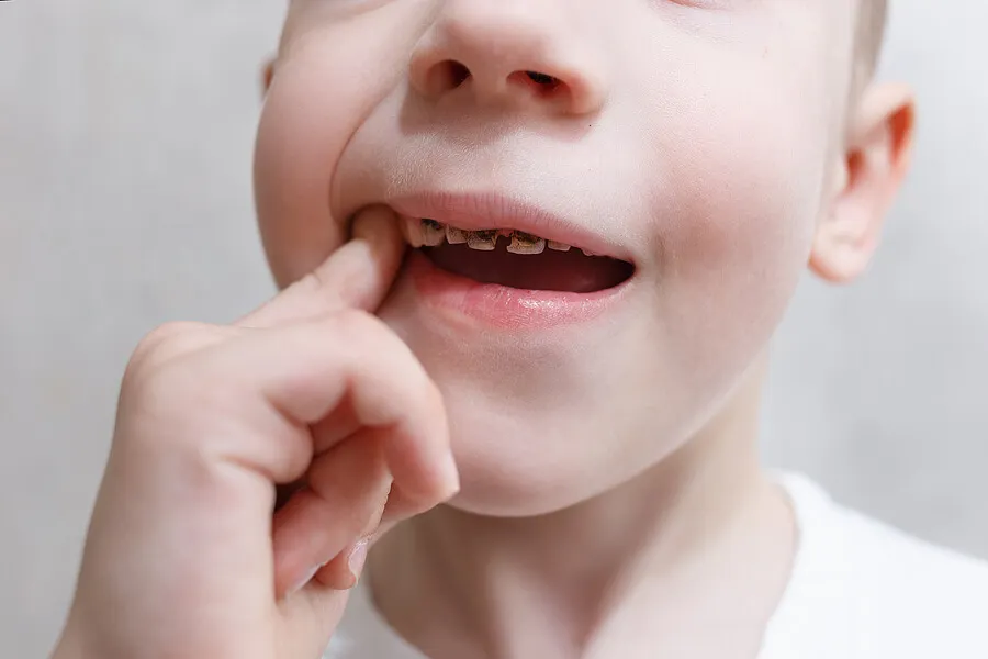 niño con caries y un dedo en la boca