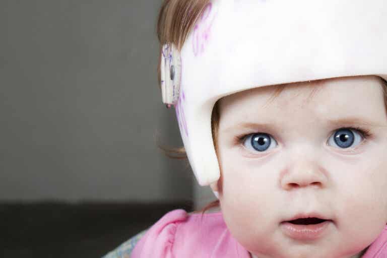 Plagiocefalia del bebé: prevención y tratamiento