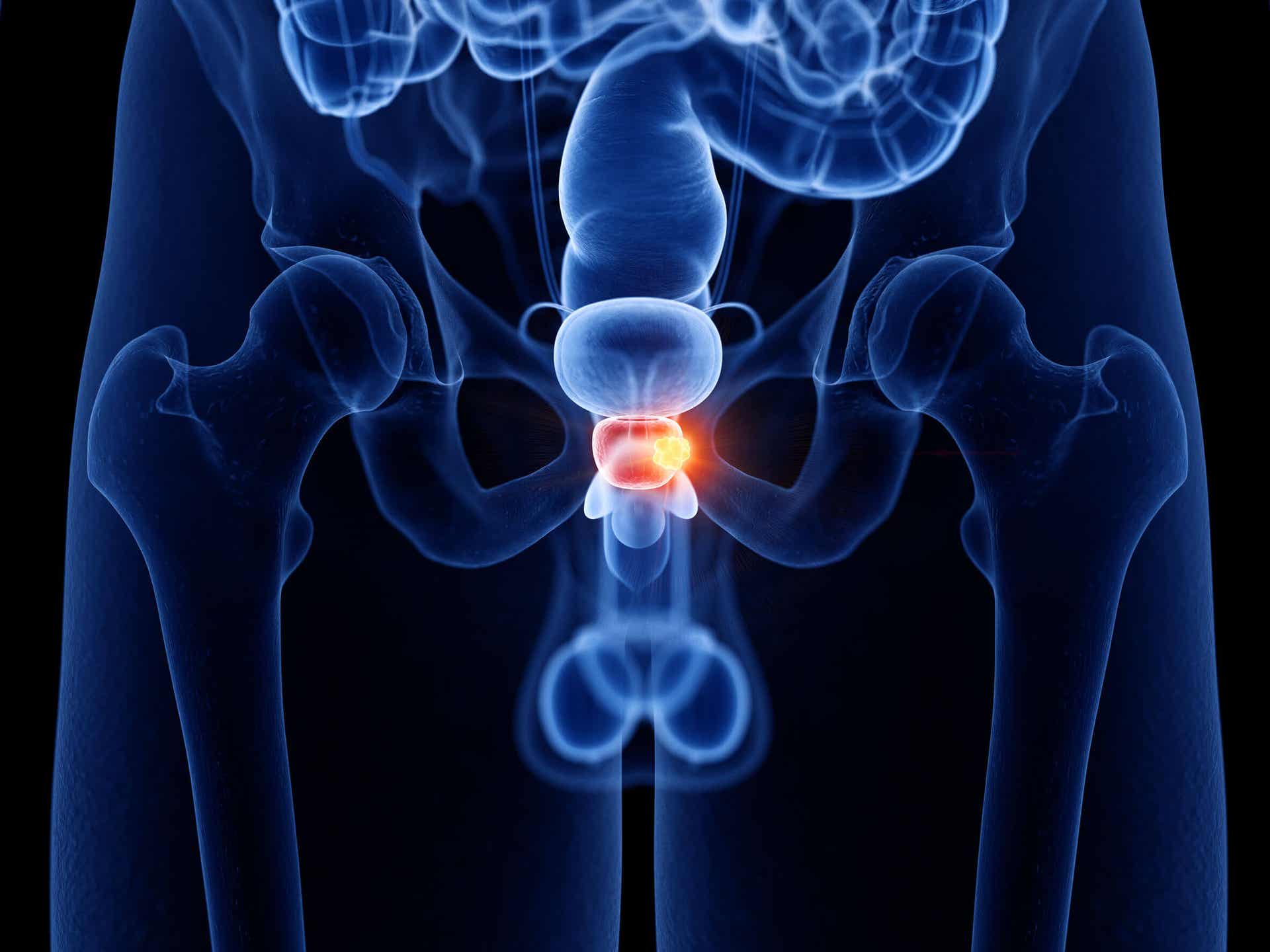 La incontinencia urinaria puede deberse a problemas de la próstata.