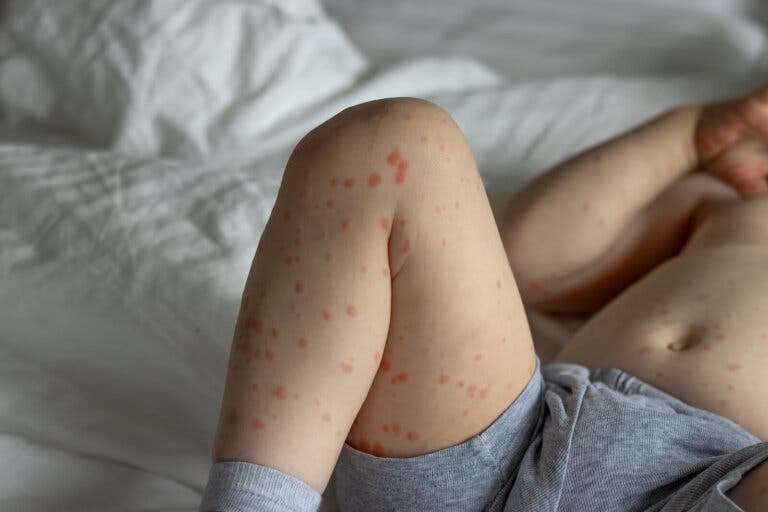 ¿Cuáles son las complicaciones de la roséola y cómo prevenirla?