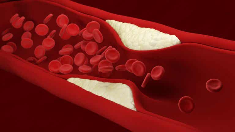 La arterioesclerosis: síntomas y tratamiento