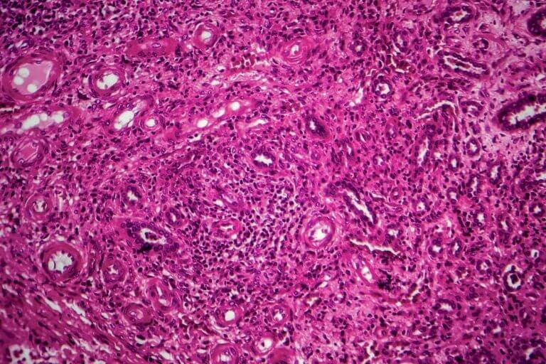Tuberculosis renal: diagnóstico y tratamiento - Mejor con Salud