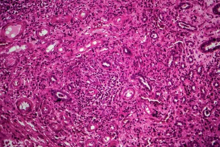 Tuberculosis renal: diagnóstico y tratamiento