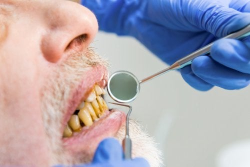 Perjuicios del tabaco en la cavidad oral