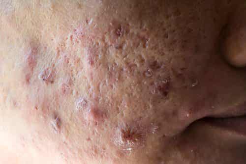 prevenir y tratar el acné