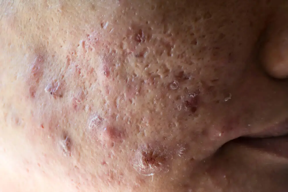 Acné hormonal
