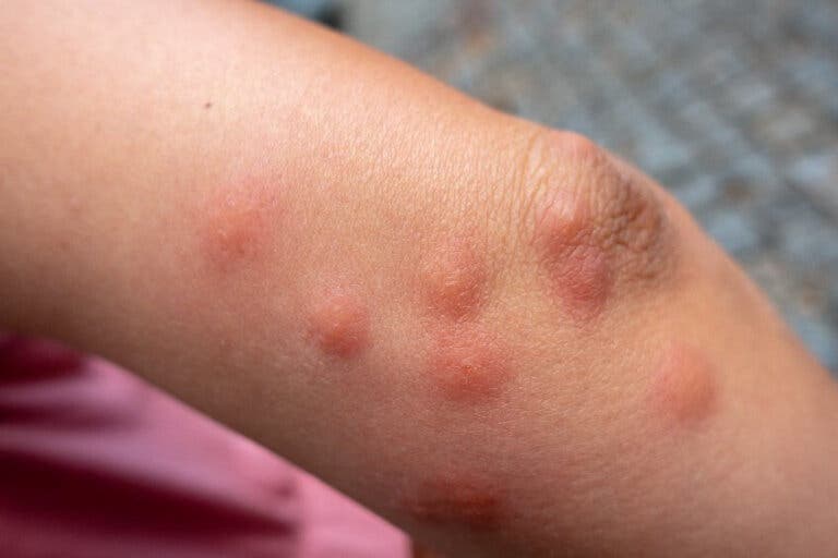 Tungiasis: síntomas y tratamiento