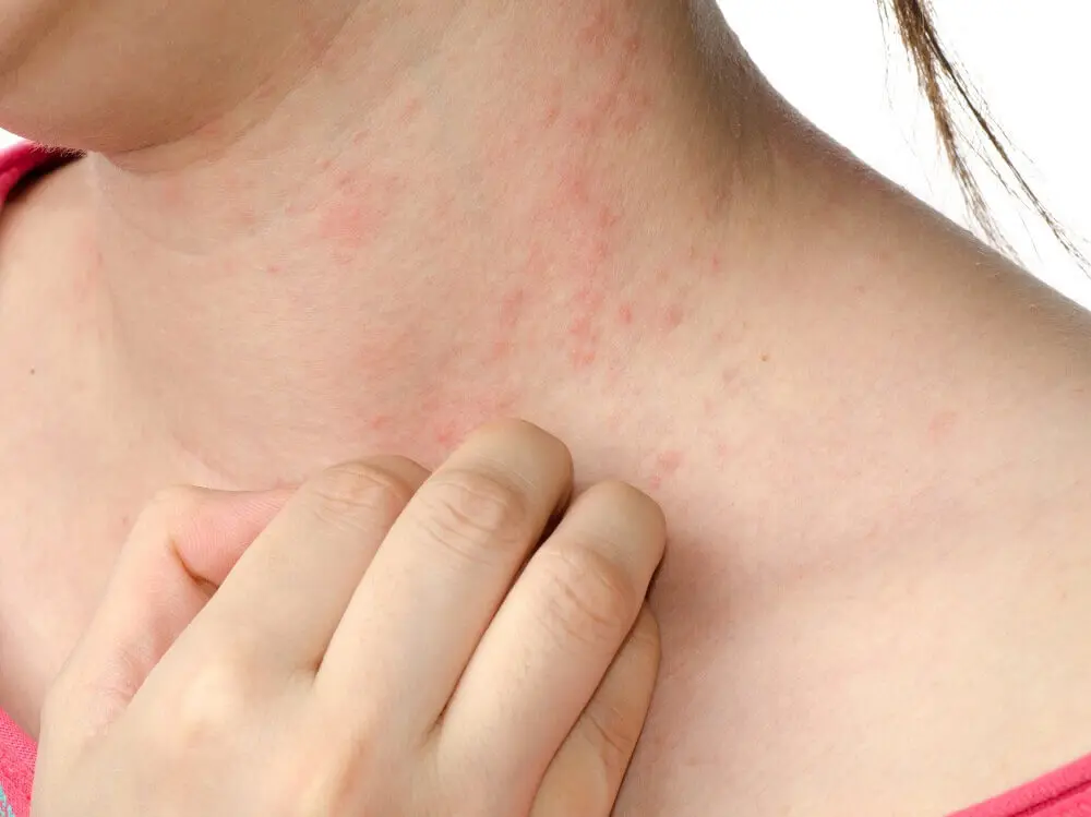 Dermatitis atópica